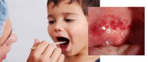 Как проявляется и лечится вирусная ангина у детей?