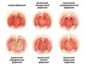 Острый фарингит у детей: особенности развития и различные способы лечения