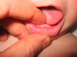 Что делать, если у ребенка появился кашель при прорезывании зубов?