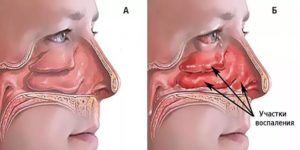 Плохо дышит нос, насморка нет: причины и особенности устранения патологии