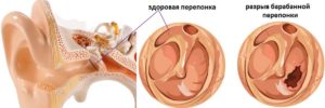 Перфорация барабанной перепонки: основные симптомы разрыва