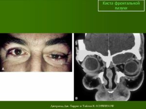 Киста лобной пазухи: причины возникновения, лечение и удаление новообразования