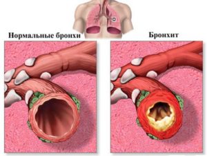 Что такое хронический бронхит, чем он опасен и как его лечить?