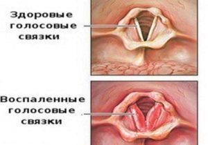 Воспаление голосовых связок стадии, формы и лечение ларингита