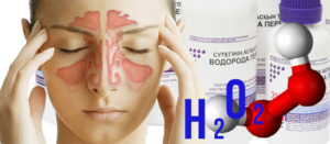 Симптомы гайморита и лечение с помощью перекиси водорода