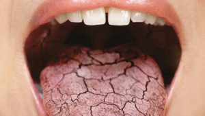 Почему сохнет во рту и как избавиться от неприятного симптома?