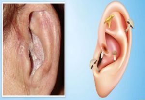 Ушной грибок у человека: основные симптомы и эффективные методы лечения отомикоза