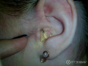 Когда и как правильно использовать фитосвечи для ушей?