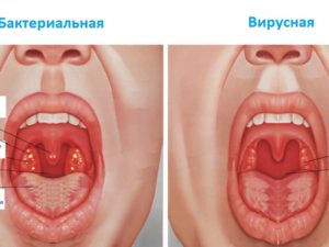 Воспаление носоглотки: признаки, лечение и профилактика заболевания