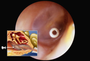 Шунтирование уха: показание, проведение и возможное осложнение