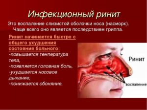 Особенности развития ринита и эффективные методы лечения воспаления слизистой оболочки носа