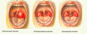 Лакунарная ангина: основные причины болезни