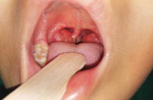 Как проявляется опухоль в горле, чем она опасна и как лечится?