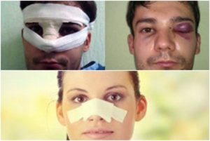 Как определить сломан нос или нет: основные признаки и методы коррекции