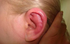 Воспаление среднего уха у детей: основные симптомы