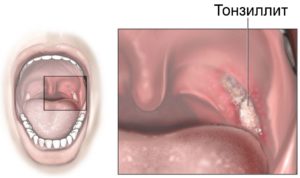 Тонзиллит: основные признаки и формы болезни