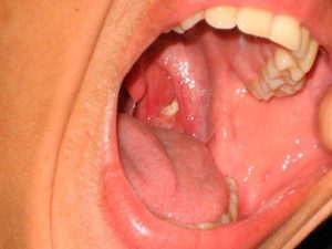 Как распознать и вылечить стафилококк во рту?