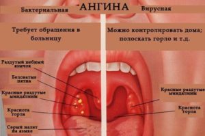 Ангина заразна или нет: способы инфицирования и лечение