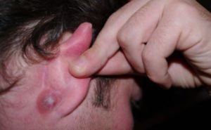 Прыщи на ушах: основные причины и способы их лечения