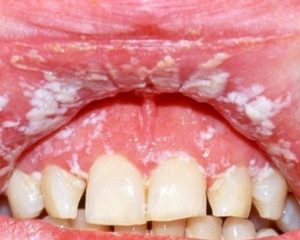 Грибок полости рта: основные признаки и способы лечения кандидоза