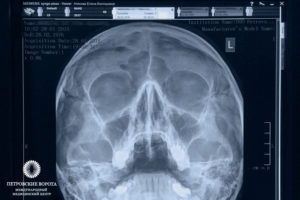 О чем может рассказать рентген носовых пазух?