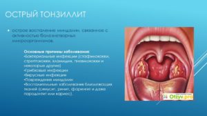 Воспаленные гланды? Признаки и эффективное лечение