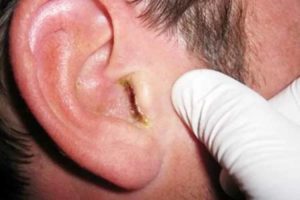 Как и чем лечить кандидоз уха?