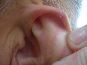 Прыщи на ушах: основные причины и способы их лечения