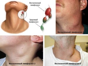 Если воспалены лимфоузлы на шее: причины, диагностика, лечение