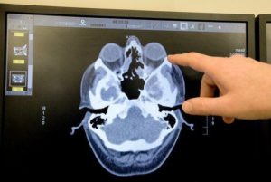 Компьютерная томография пазух носа: процедура и возможные результаты