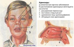 Консервативное лечение аденоидов у детей: симптомы болезни и основные принципы лечения