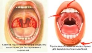 Ангина заразна или нет: способы инфицирования и лечение