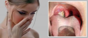 Неприятный запах из горла: основные причины симптома