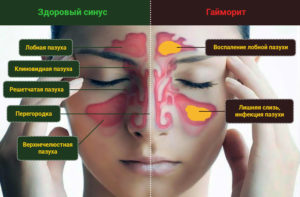 Особенности развития гайморита у беременных и безопасные методы лечения