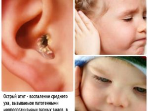 Отит у ребенка: признаки, правильное лечение и возможные осложнения осложнения