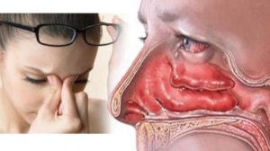 Почему постоянно заложен нос? Возможные причины и методы лечения