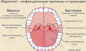 Фарингит: эффективное лечение в домашних условиях