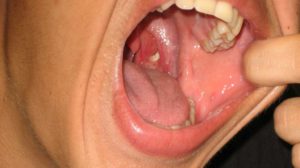Первые симптомы рака горла и методы лечения патологии