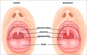 Выделение слизи из горла: симптоматика и способы лечения