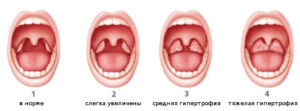 Гипертрофия миндалин у детей: признаки, лечение и удаление миндалин