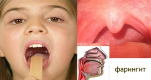 Чем лечить очень красное горло у ребенка лекарства и народные средства