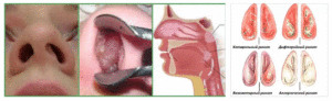 Синдром постназального затекания признаки заболевания, лечение и профилактика