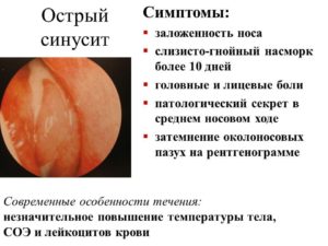 Синусит у детей: причины, симптомы и лечение заболевания