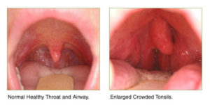 Как выглядит больное горло и как правильно его лечить?