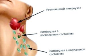 Что делать, если болит лимфоузел на шее слева?