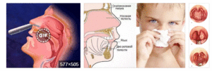 Синдром постназального затекания признаки заболевания, лечение и профилактика