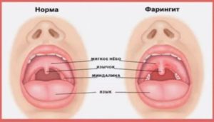 Что делать, если болит горло при беременности: причины, симптоматика и лечение