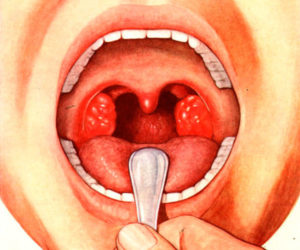 Воспаление миндалин: симптомы и возможные осложнения