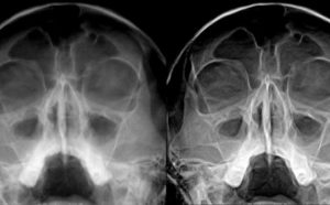 Гайморит на рентгеновском снимке: расшифровка рентгенограммы
