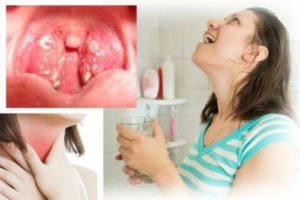 Самые эффективные методы лечения больного горла в домашних условиях